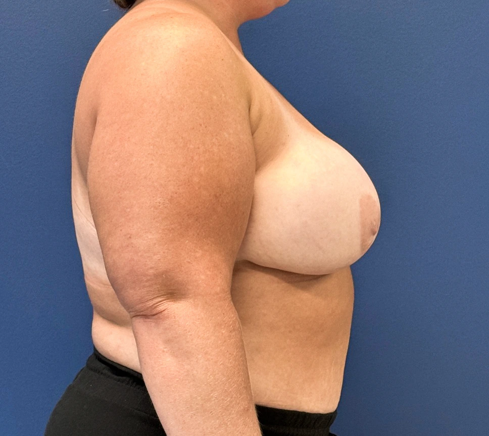 DIEP-Flap-Case--27595 | After DIEP Flap 3