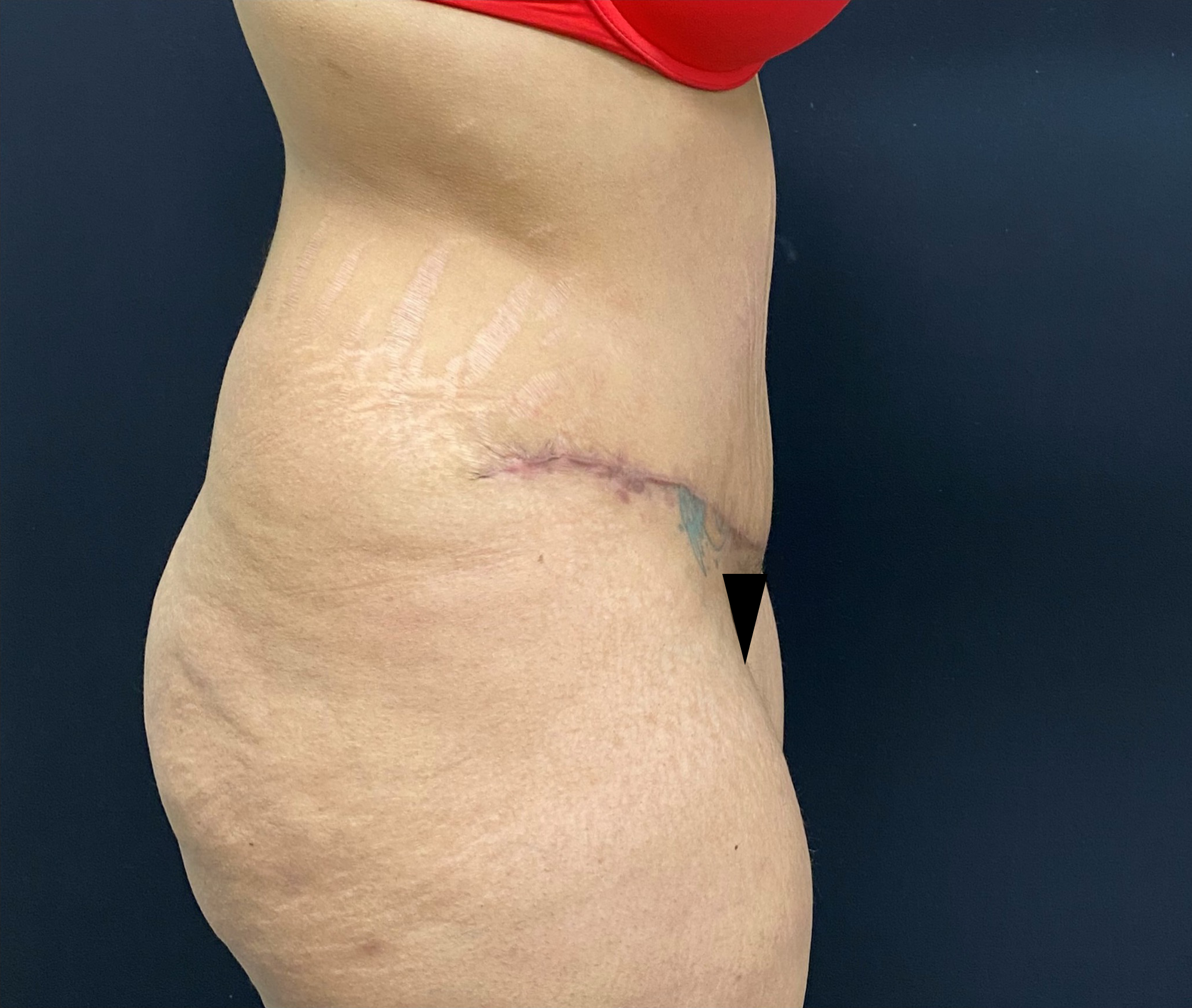Liposuction-Tummy-Tuck-Case--338 | After Liposuction 4