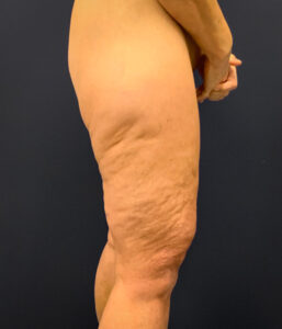 Thighplasty-Case--2024 | After Dr. Arjun Kanuri 2