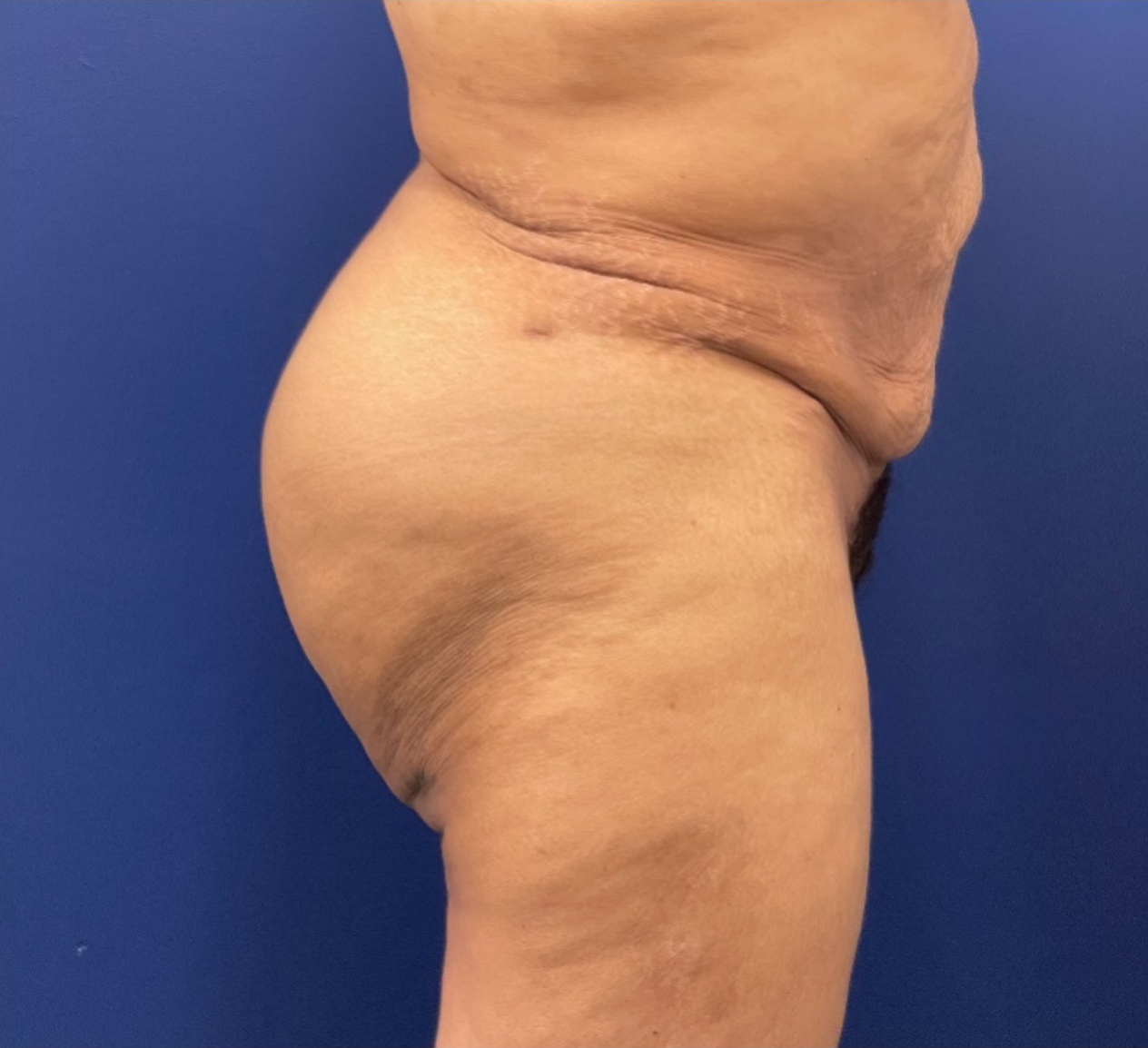 Brazilian-Butt-Lift-Case--215 | After Brazilian Butt Lift 3