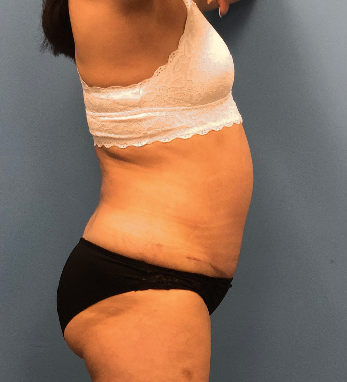 Case--14819 | After Liposuction 3