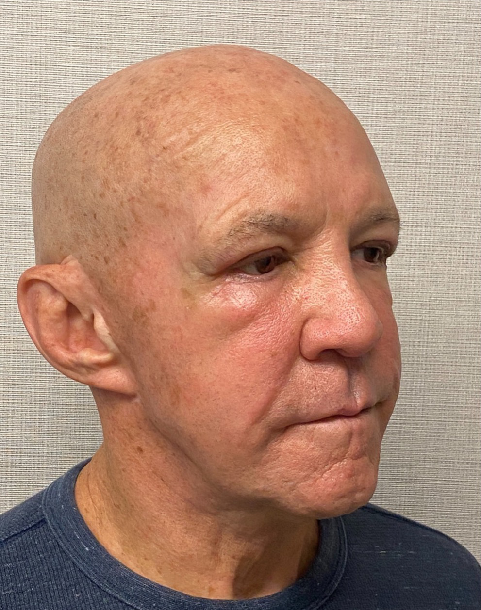 Blepharoplasty-Case--24169 | After Eyelid Surgery 4
