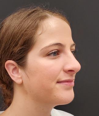 Rhinoplasty-and-Chin-Implant-Case--381 | After Rhinoplasty 2