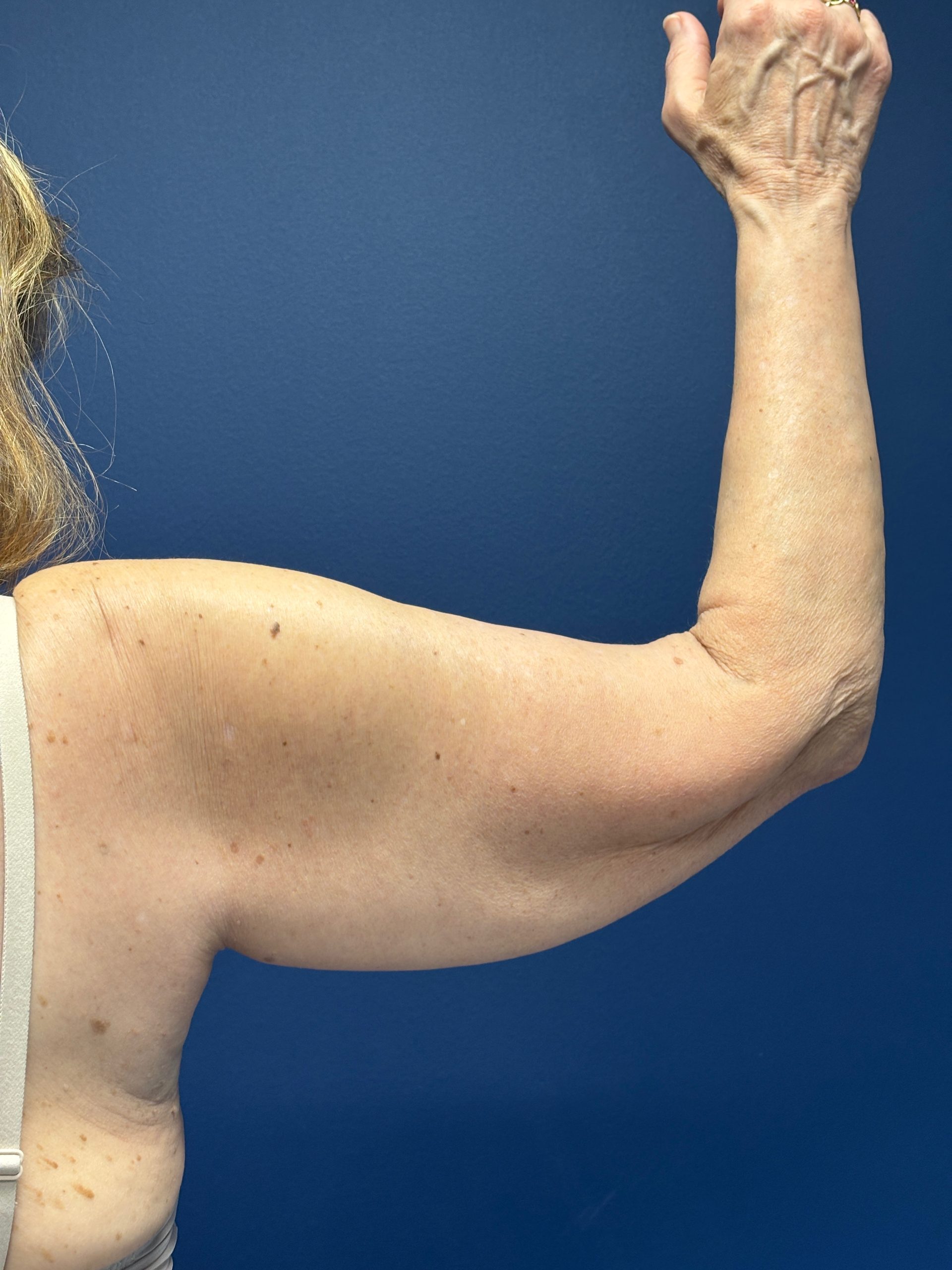 Brachioplasty-Case--3625 | Before Arm Lift 3