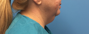 Case--391 | Before Submental Liposuction 1