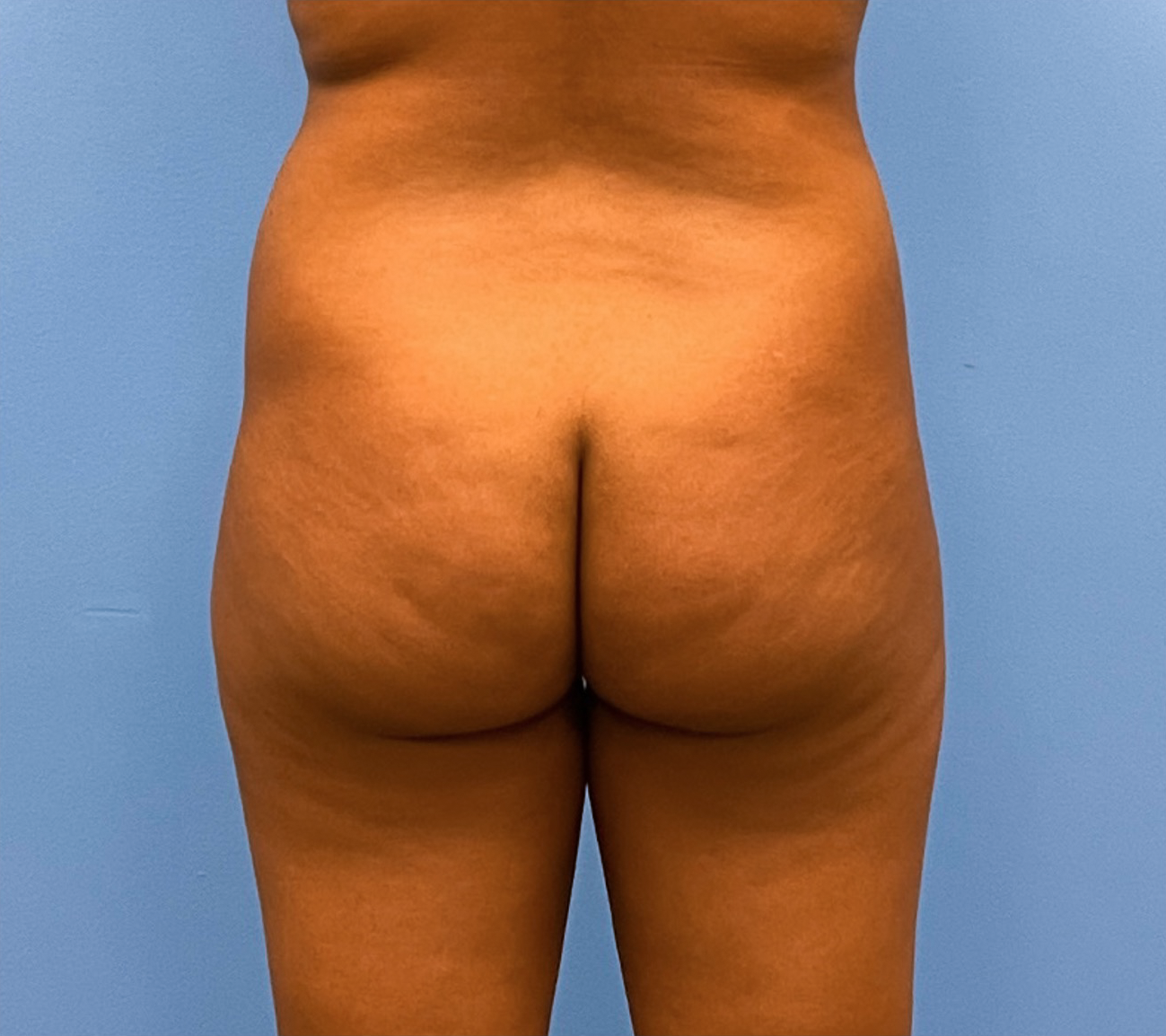 Brazilian-Butt-Lift-Case--263 | Before Brazilian Butt Lift 1