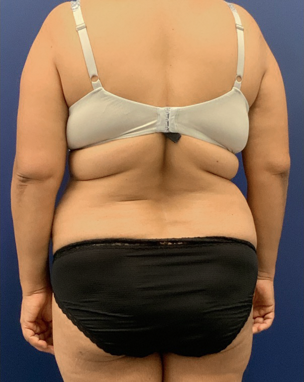 Liposuction-Abdominoplasty-Case--25576 | Before Liposuction 6