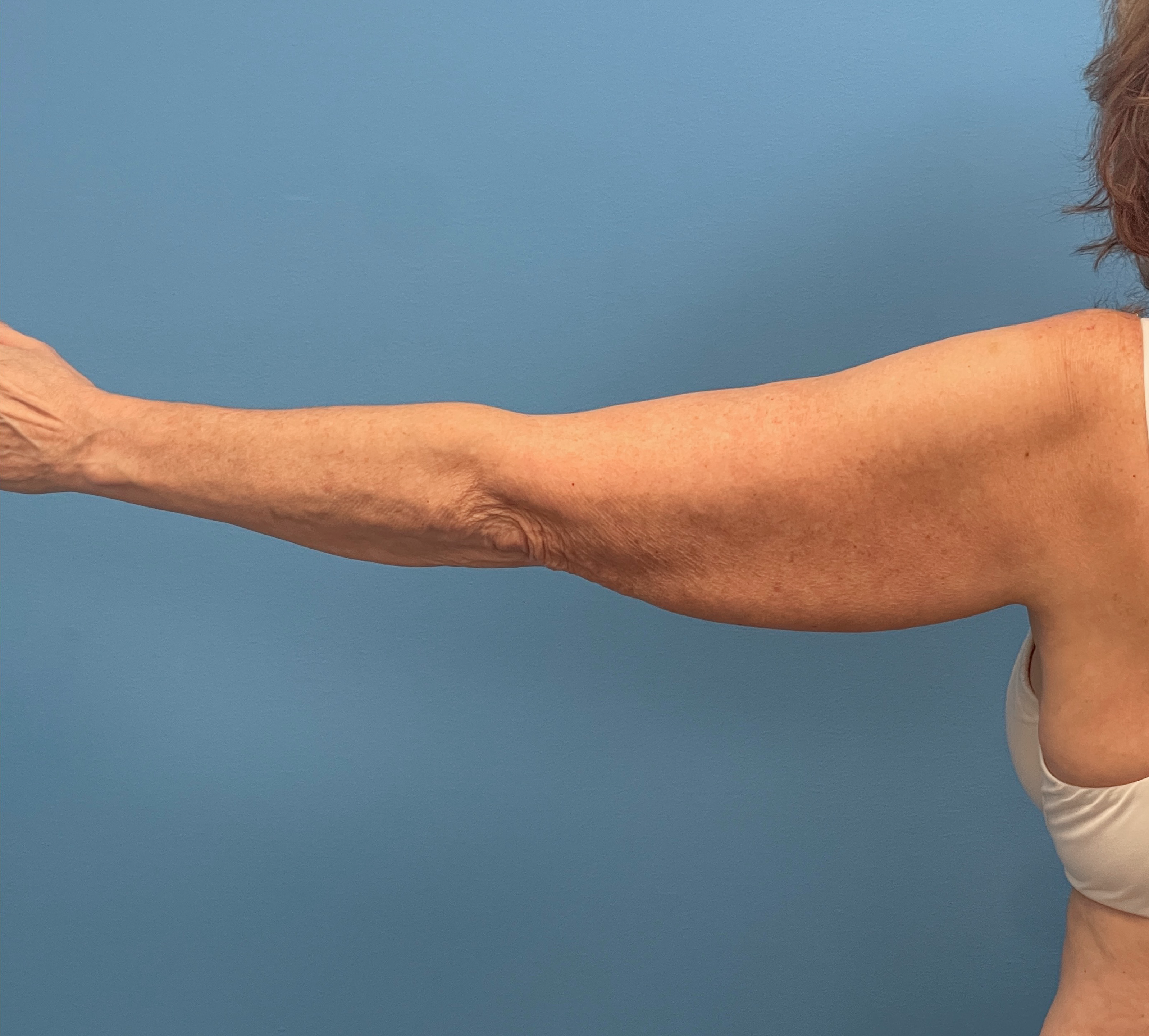 Liposuction-Case--23690-2 | Before Liposuction 4