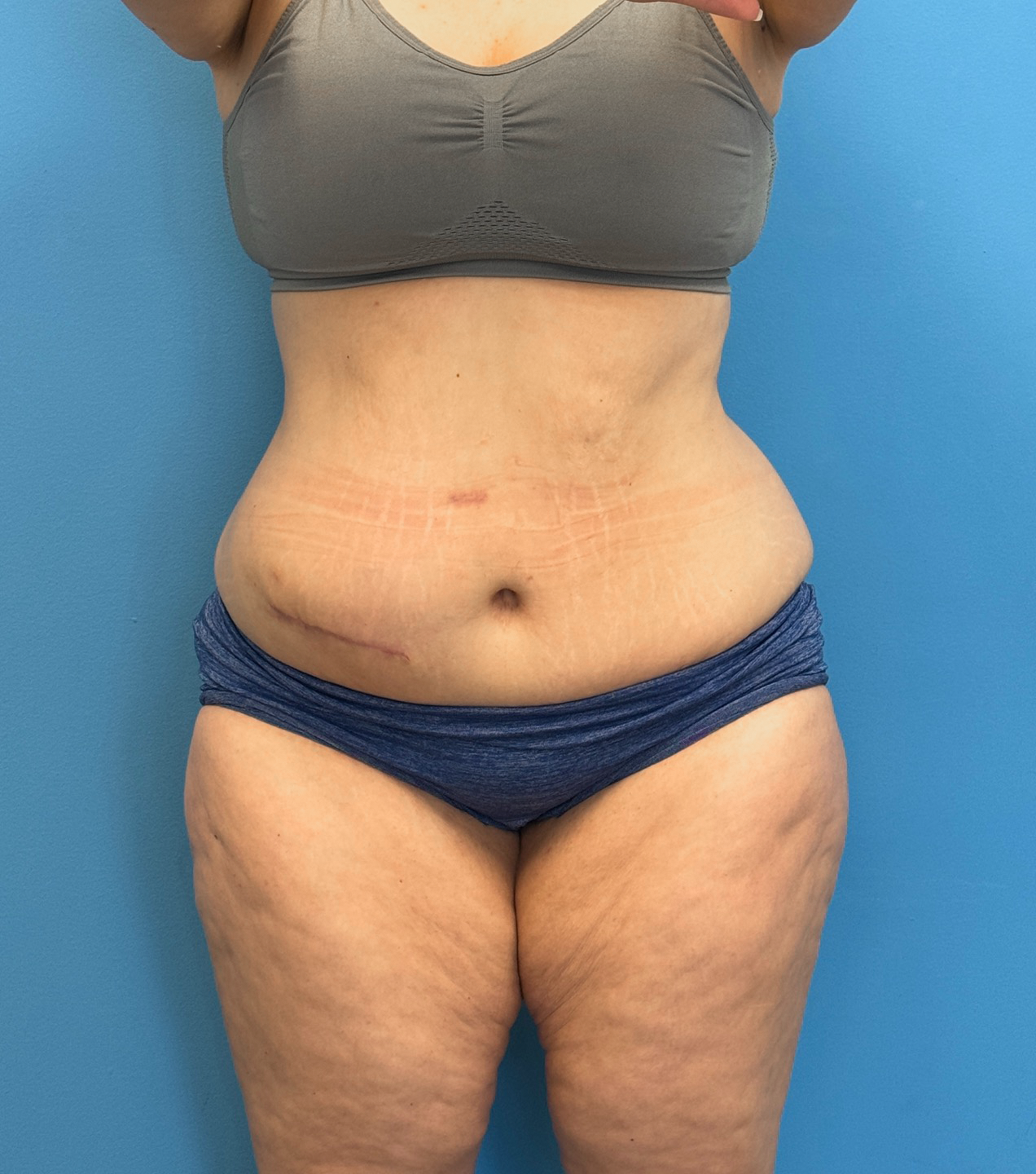 Tummy-Tuck-Case--28426 | Before Tummy Tuck 1