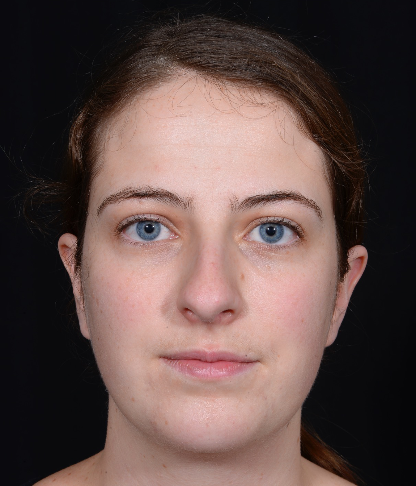 Rhinoplasty-and-Chin-Implant-Case--381 | Before Rhinoplasty 1