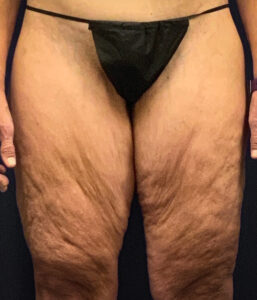 Thighplasty-Case--2024 | Before Dr. Arjun Kanuri 1