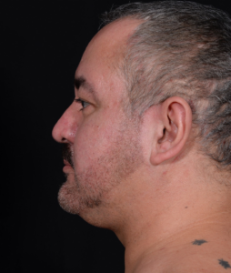 Liposuction-Case--368 | Before Submental Liposuction 2