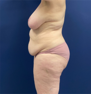 Mommy-Makeover-Case--26853 | Before Mommy Makeover 2