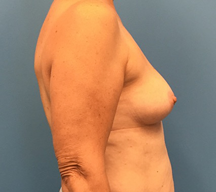 Case--133 | Before Breast Reconstruction 3