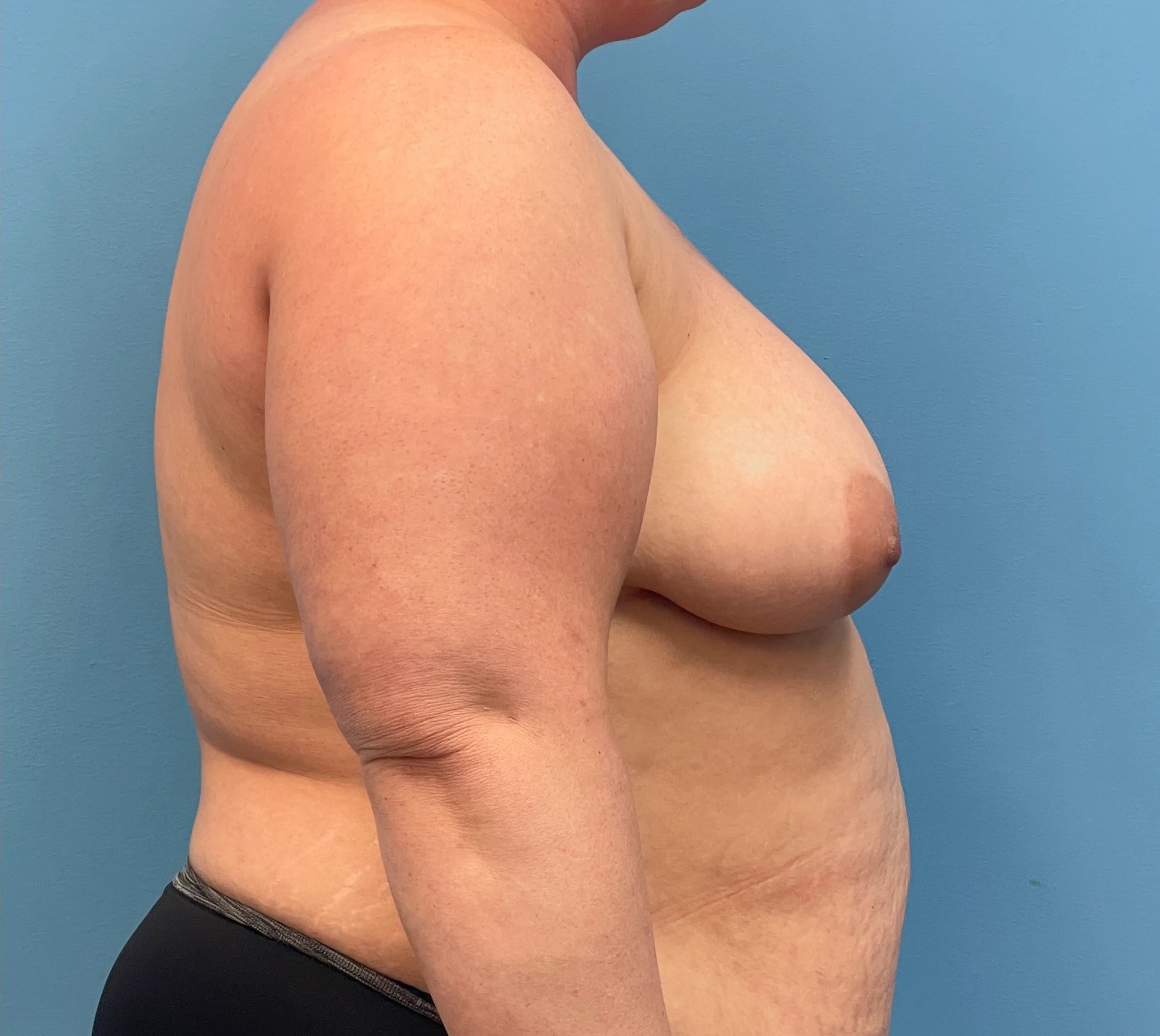 DIEP-Flap-Case--27595 | Before DIEP Flap 3