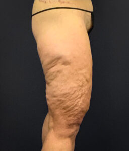 Thighplasty-Case--2024 | Before Dr. Arjun Kanuri 2