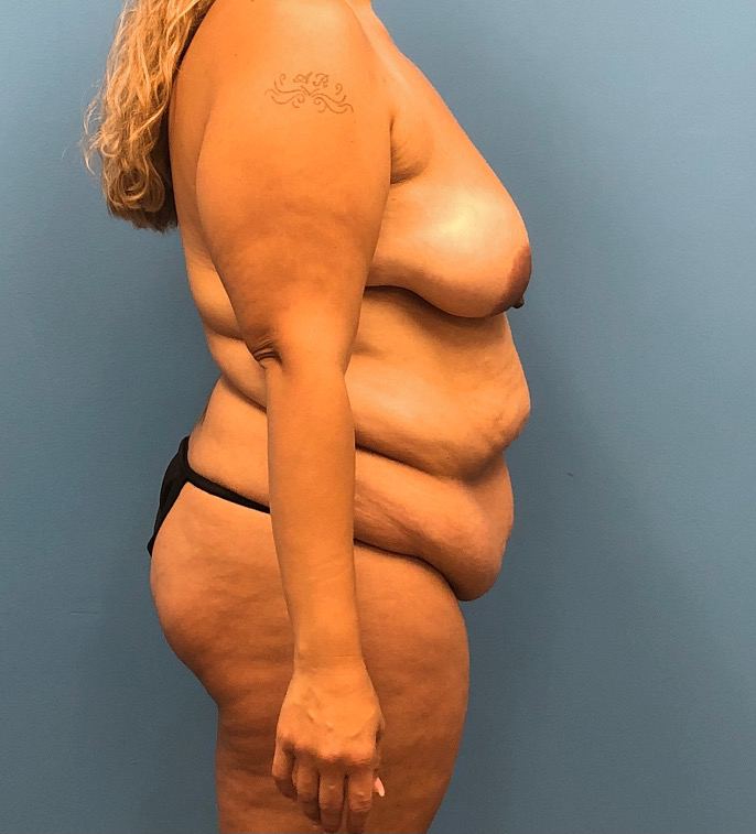 Lipoabdominoplasty-Breast-Augmentation-Case--15133 | Before Mommy Makeover 3