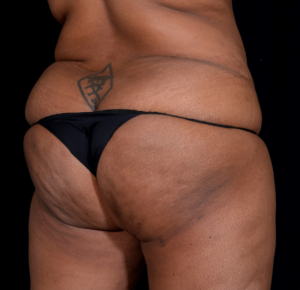 Brazilian-Butt-Lift-Case--352 | Before Brazilian Butt Lift 2