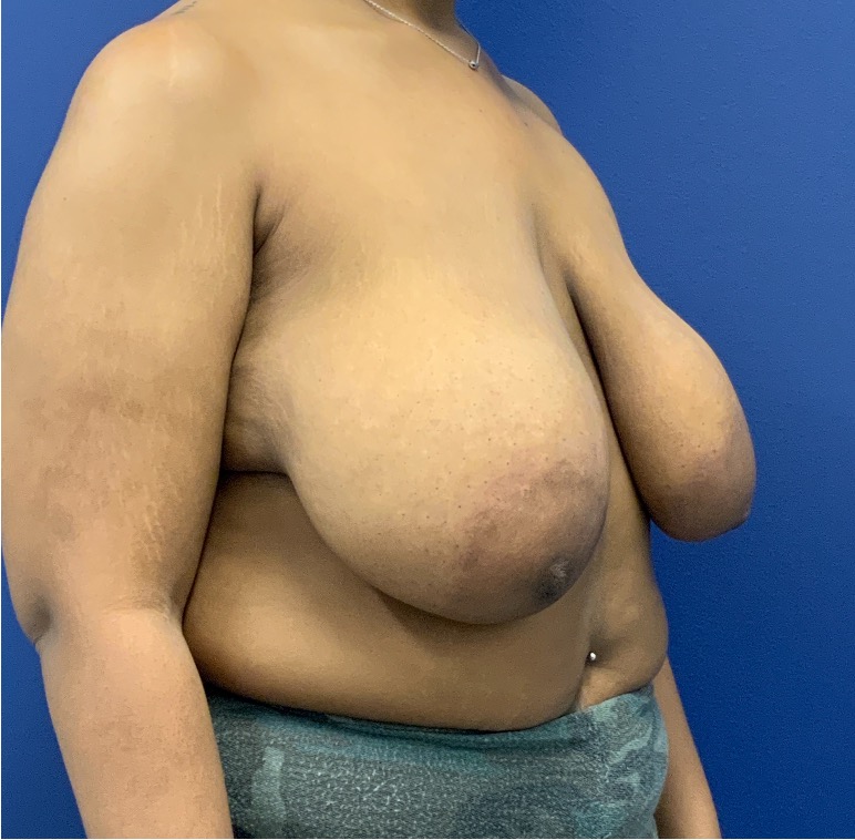 Breast-Reduction-Case--27281 | Before Breast Reduction 4