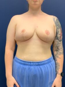 Breast-Reduction-Case--2527 | After Dr. Frank Albino 1