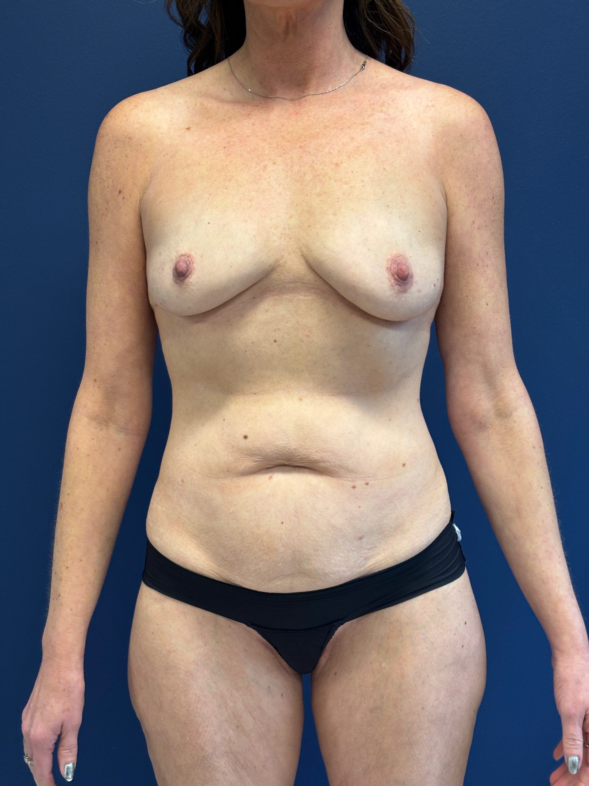 Abdominoplasty-Case--2448 | Before Tummy Tuck 1