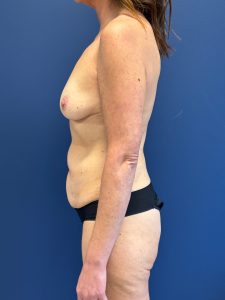 Abdominoplasty-Case--2448 | Before Tummy Tuck 2