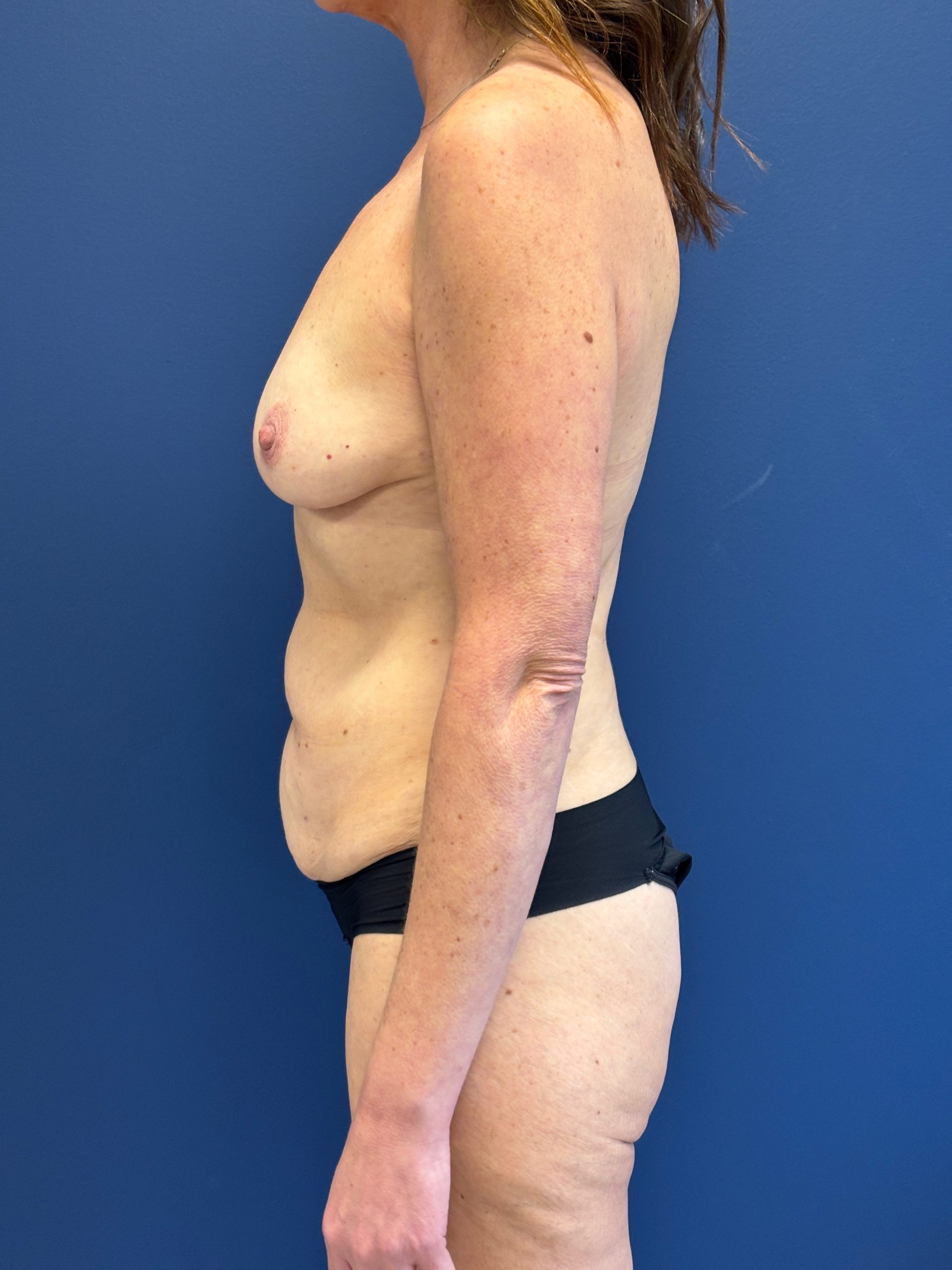 Abdominoplasty-Case--2448 | Before Tummy Tuck 2
