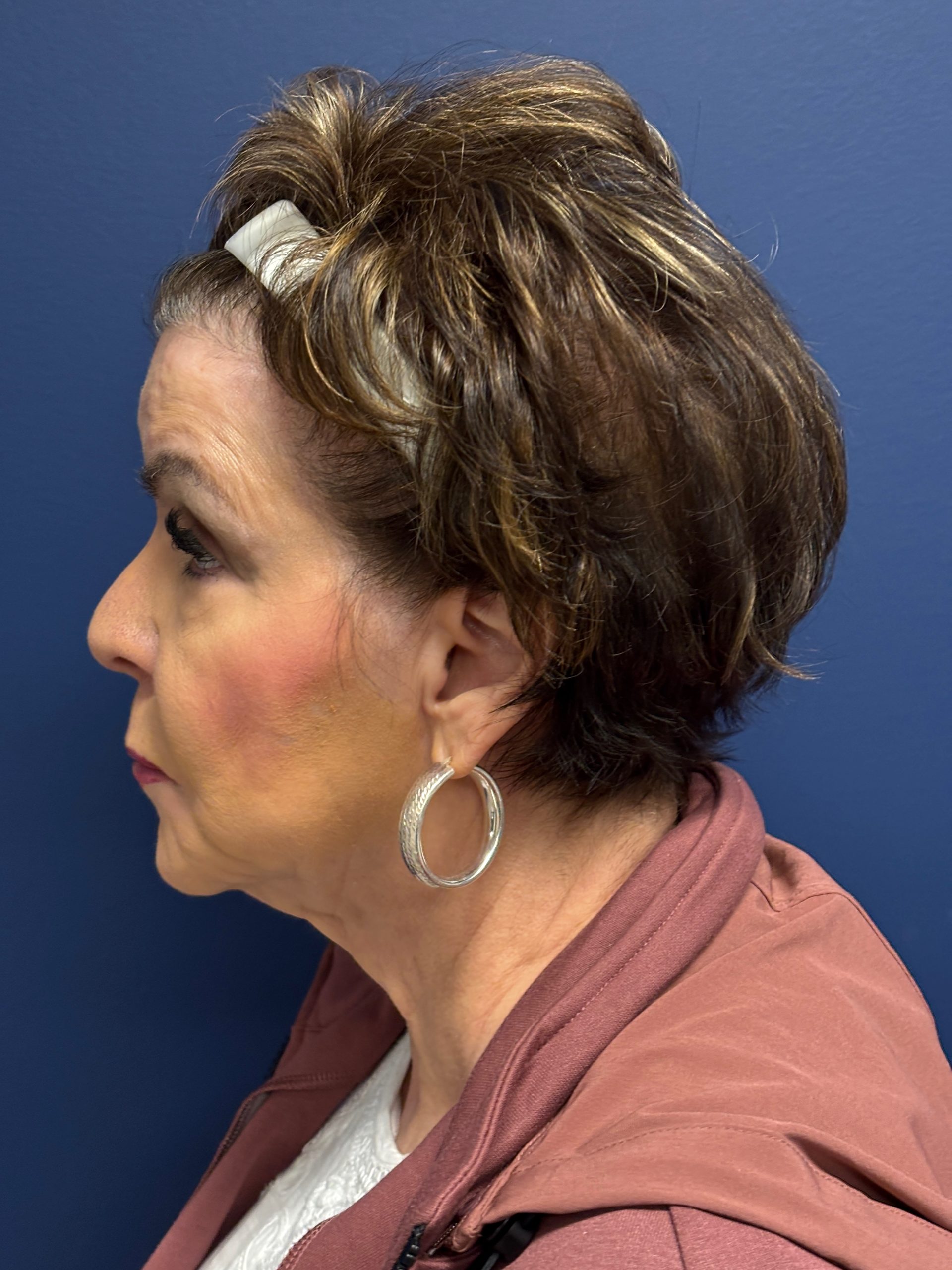 Facelift-Case--6613 | Before Facelift 2