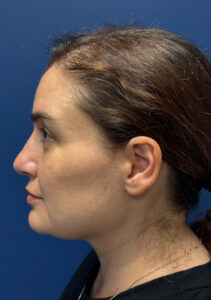 Facelift-and-Facial-Fat-Grafting-Case--7977 | After Facial Fat Grafting 2