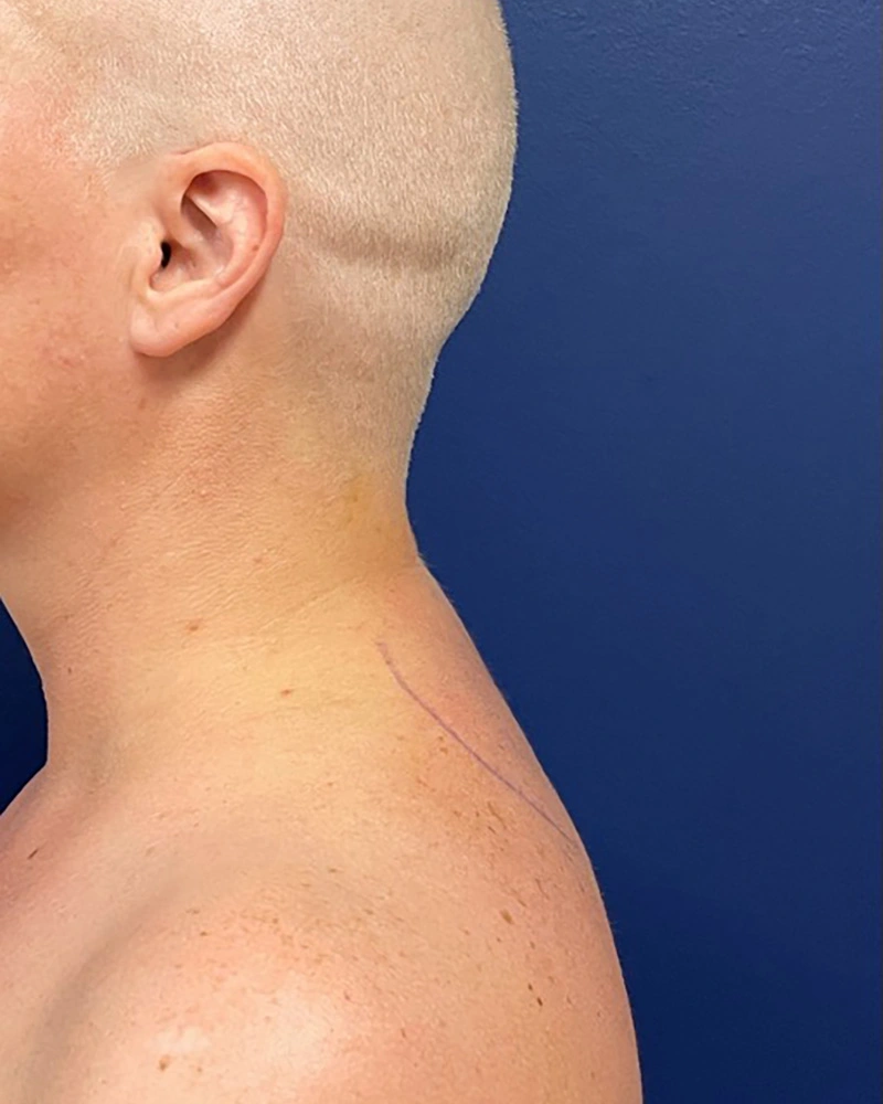 Submental-Liposuction-Case--9534 | After Submental Liposuction 1