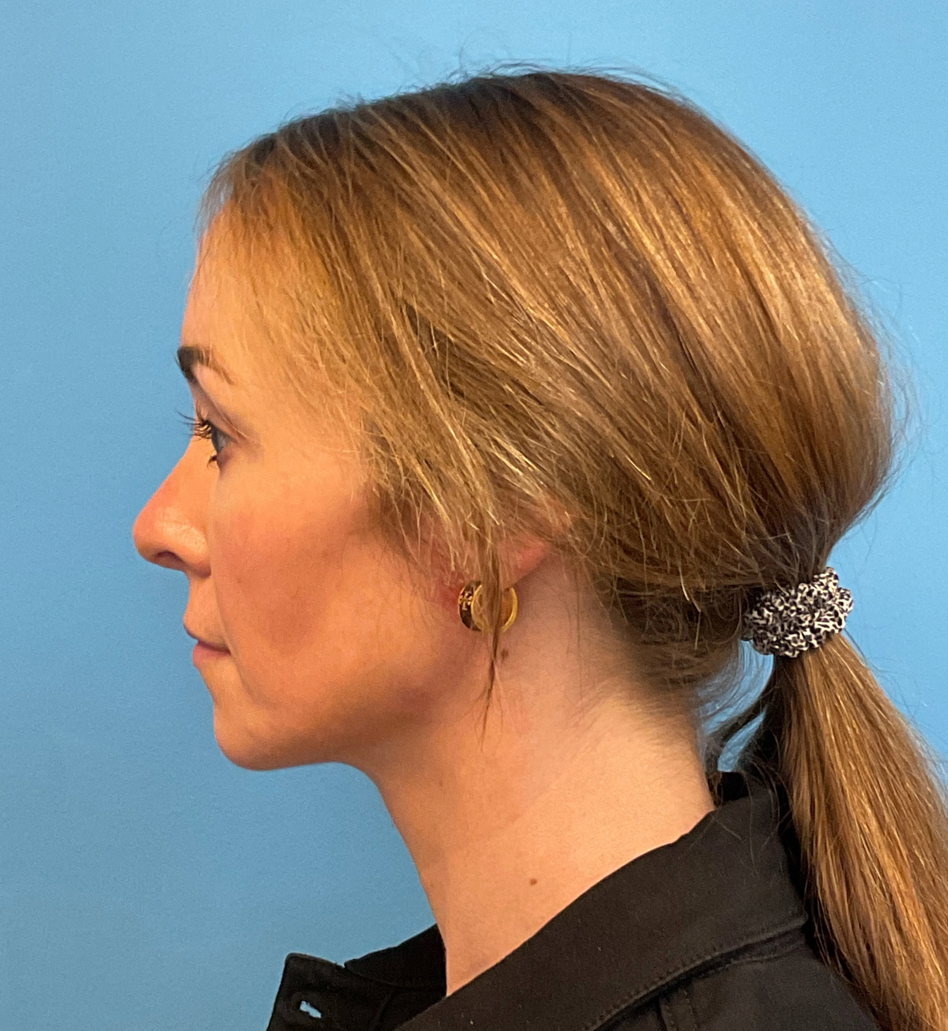Rhinoplasty-Case--1281 | After Rhinoplasty 3