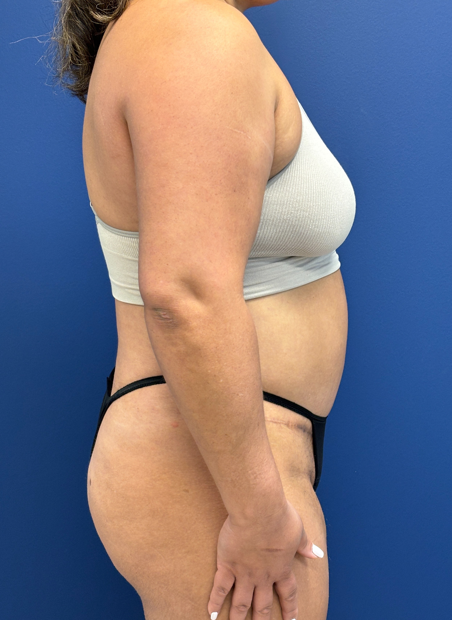Abdominoplasty-Case--9870 | After Body 2