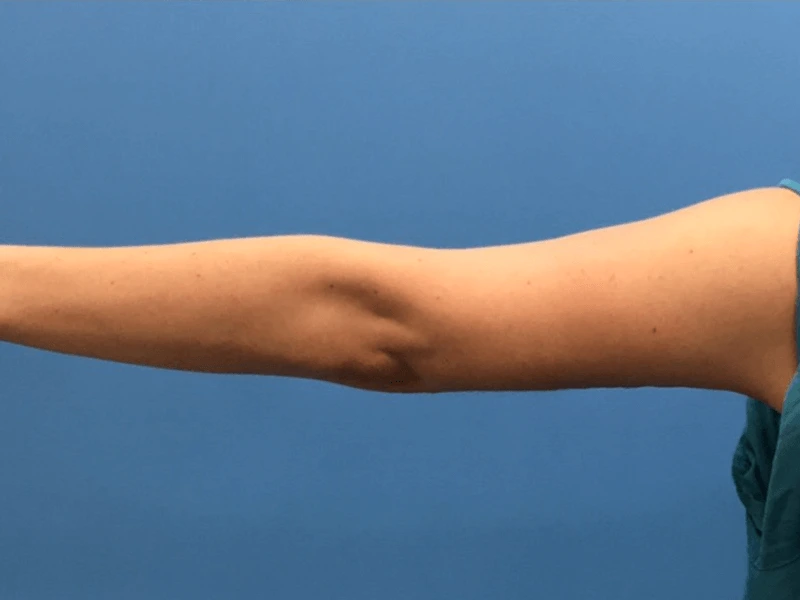 Brachioplasty-Case--276 | After Arm Lift 1