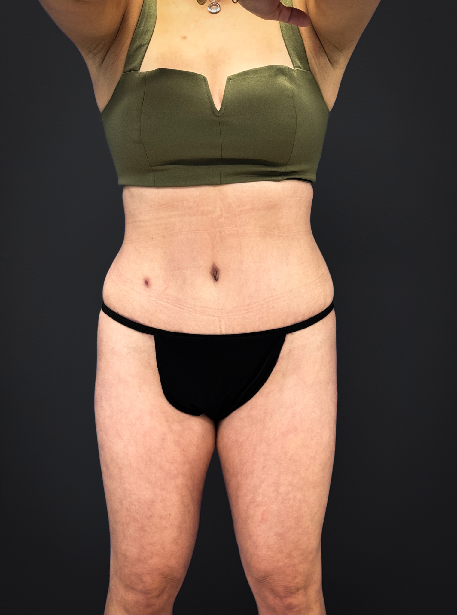Tummy-Tuck-Case--3757 | After Body 1