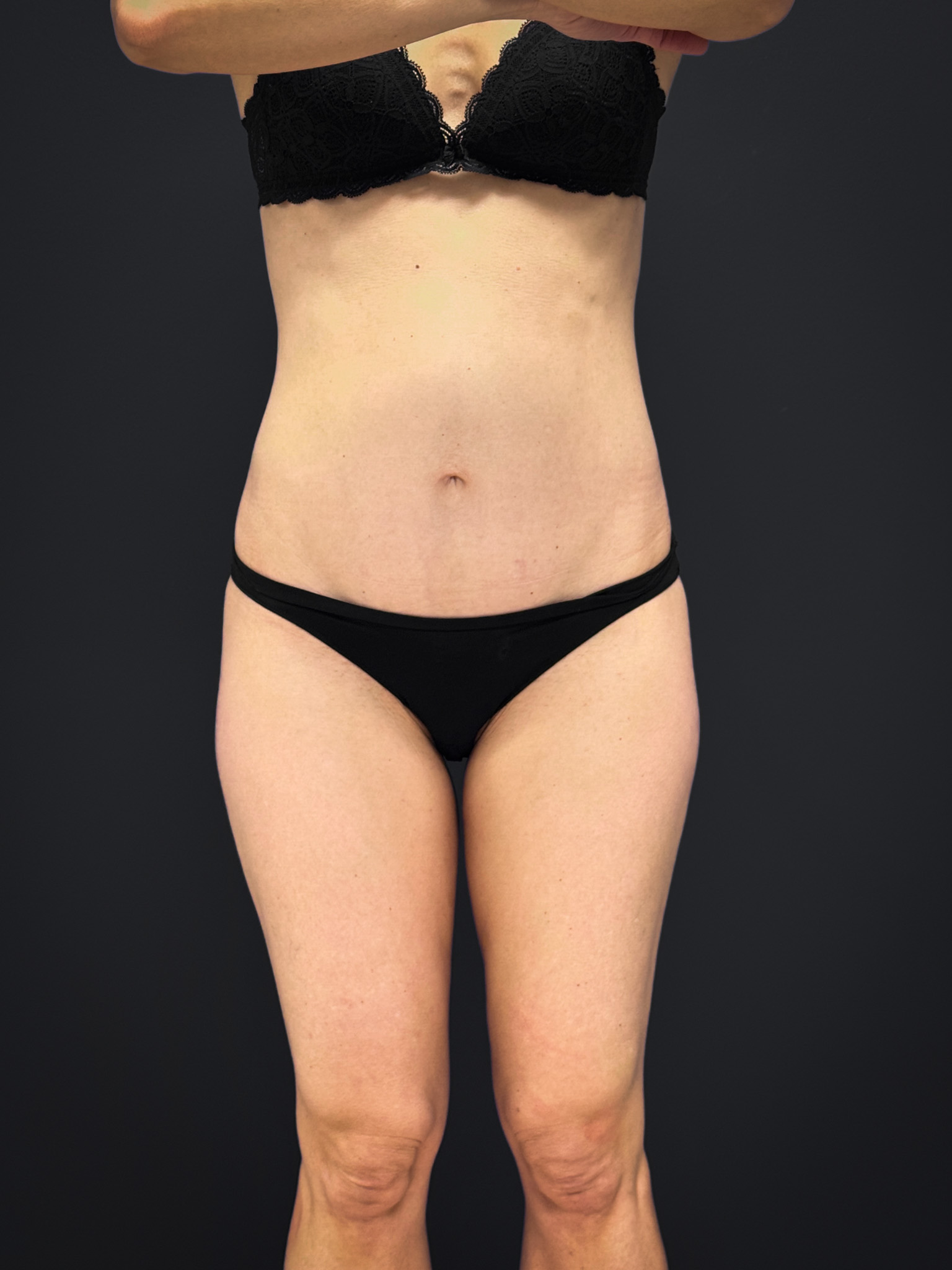Tummy-Tuck-Case--2729 | After Body 1