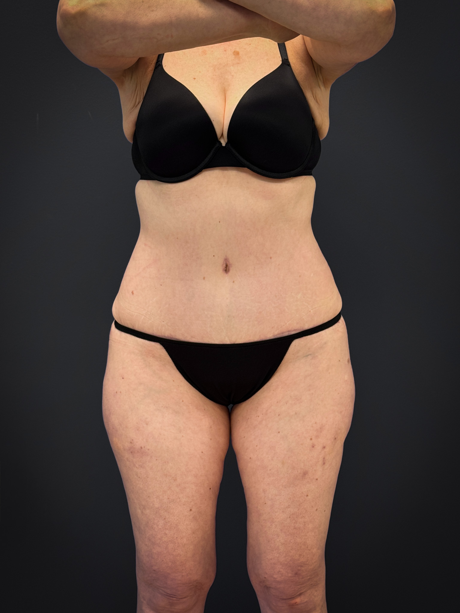 Tummy-Tuck-Case--7170 | After Body 1