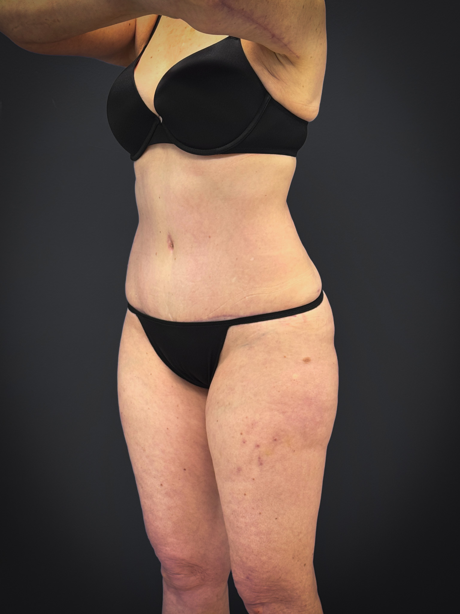 Tummy-Tuck-Case--7170 | After Body 2