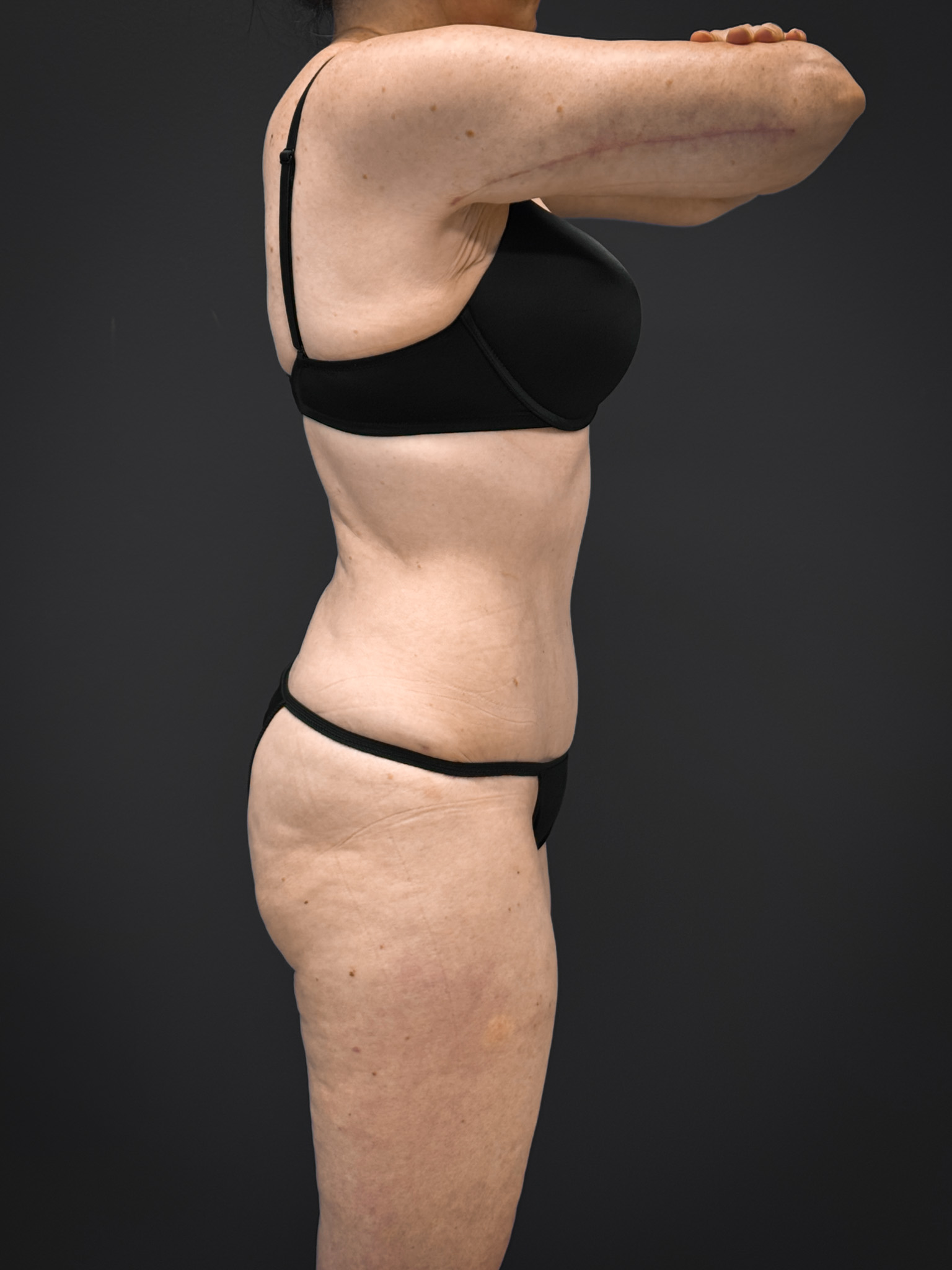 Tummy-Tuck-Case--7170 | After Tummy Tuck 5