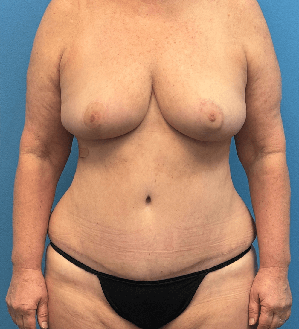 Mommy-Makeover-Case--27387 | After Body 1