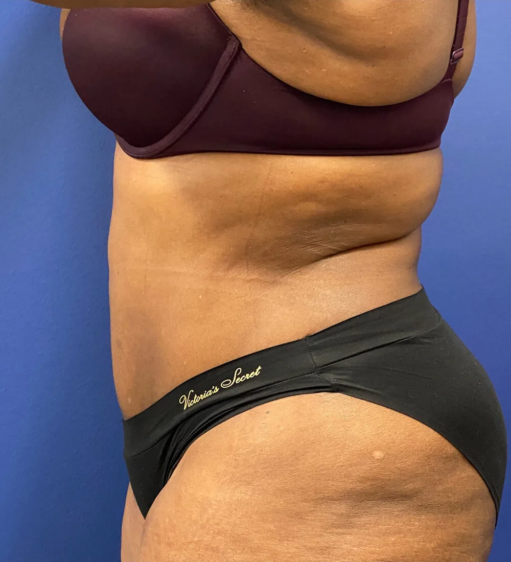 Lipoabdominoplasty-Case--24124 | After Tummy Tuck 3
