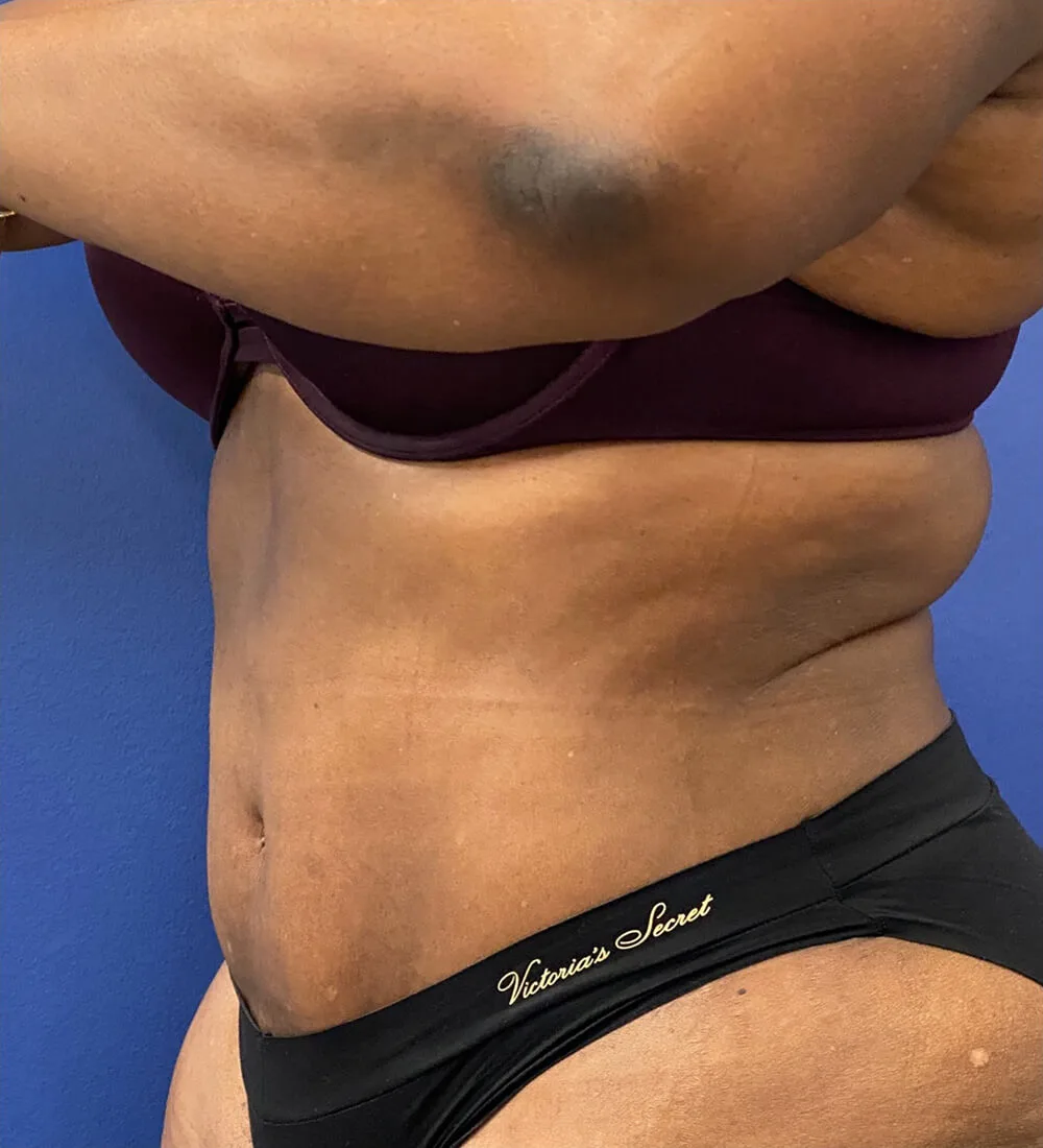 Lipoabdominoplasty-Case--24124 | After Tummy Tuck 4
