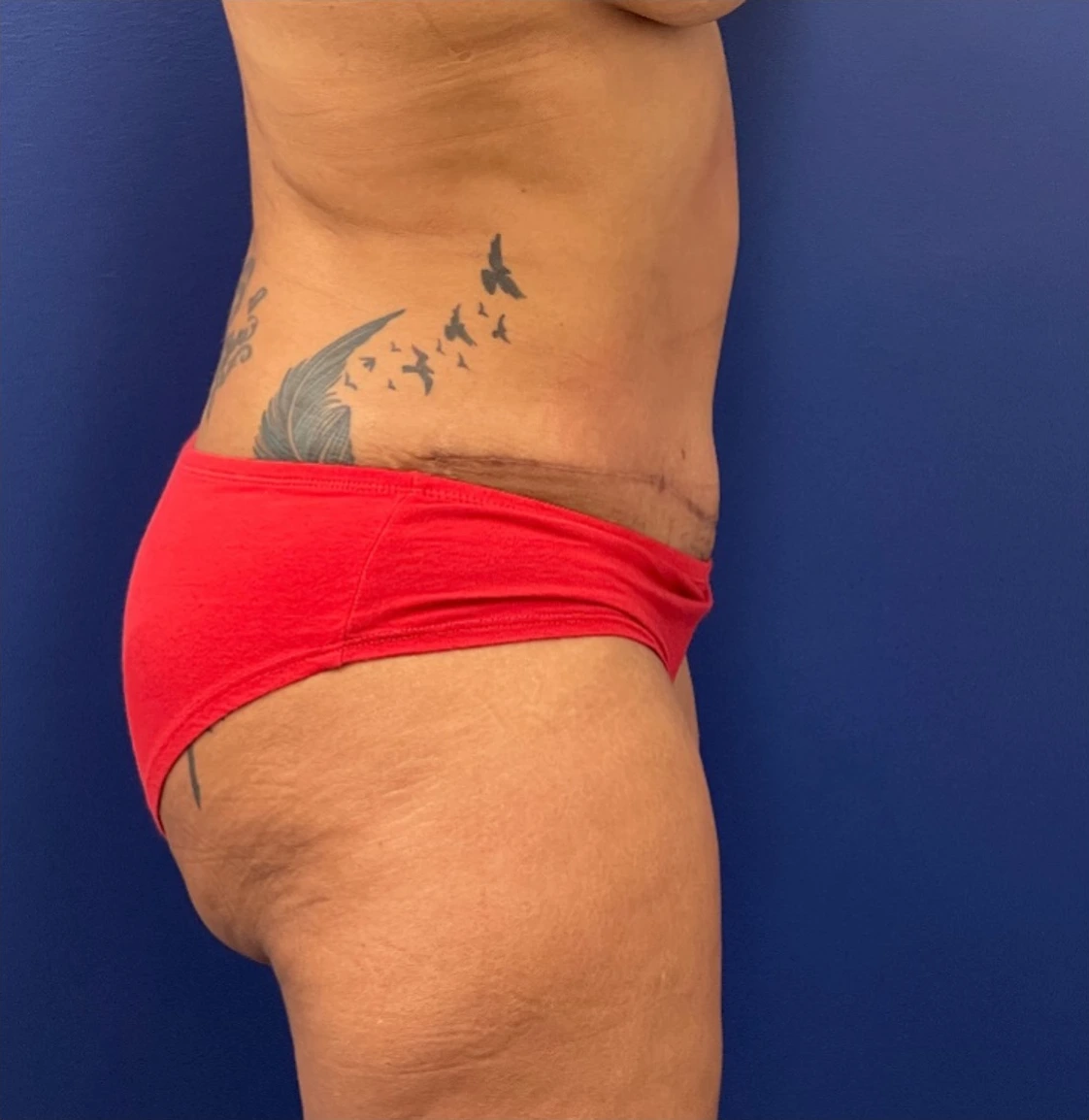 Liposuction-Case--254 | After Body 2