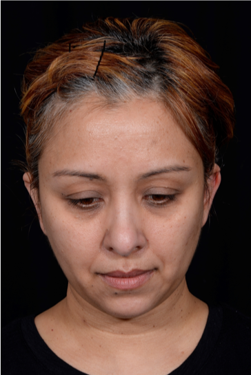 Otoplasty-Case--4655 | After Otoplasty 4