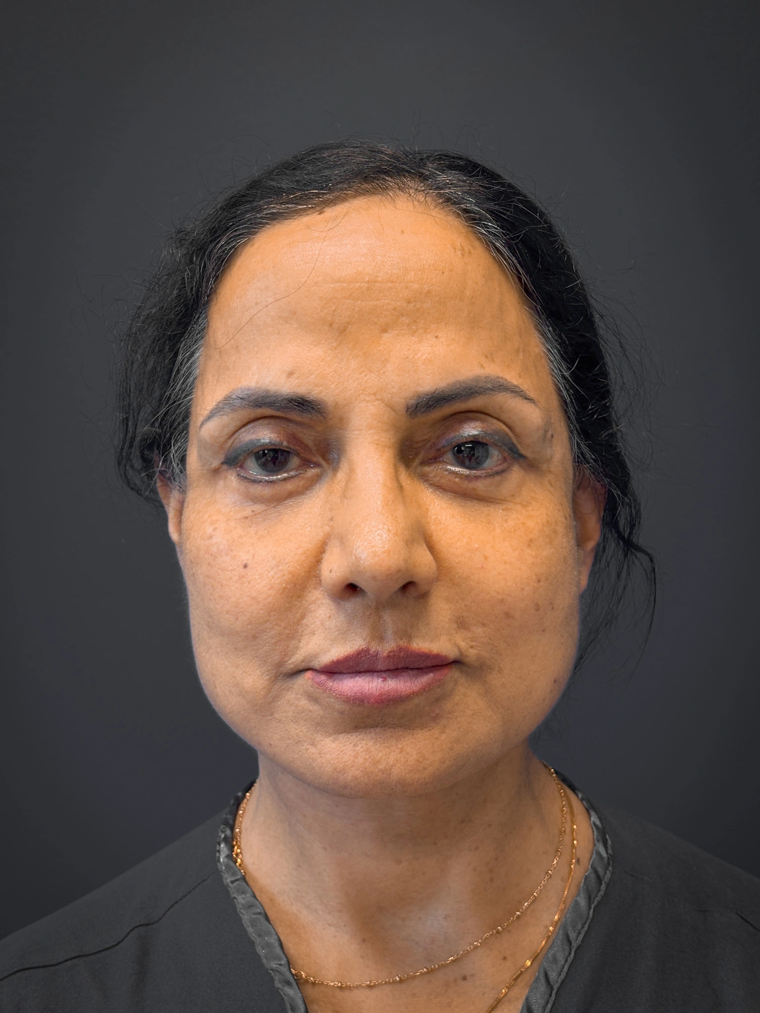 Facelift-and-Facial-Fat-Grafting-Case--8416 | After Facelift 1