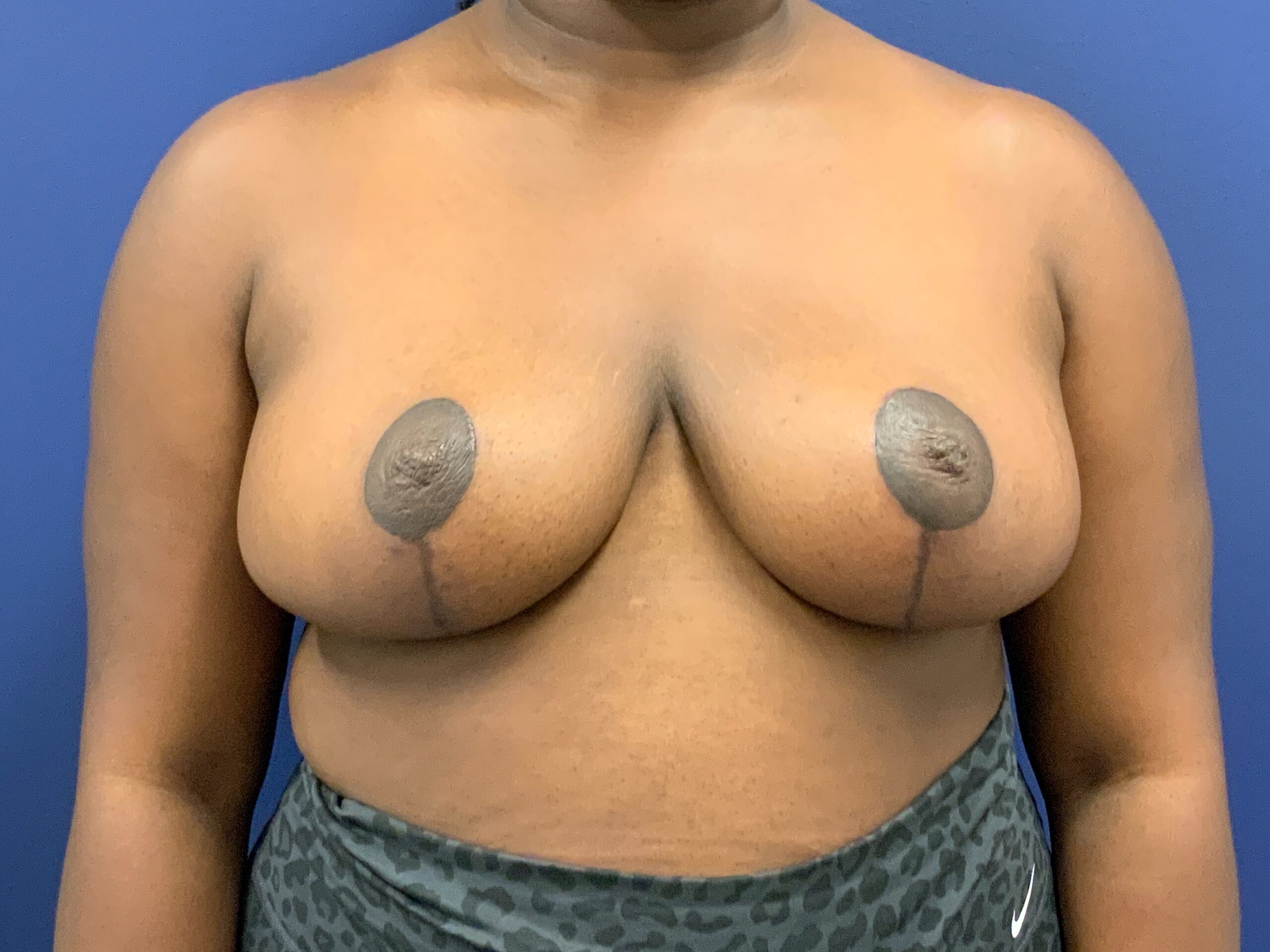 Breast-Reduction-Case--7783 | After Dr. Arjun Kanuri 1