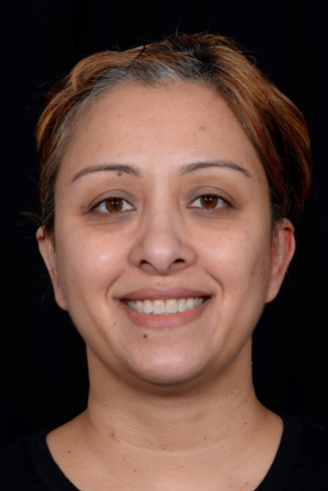 Otoplasty-Case--4655 | After Otoplasty 1
