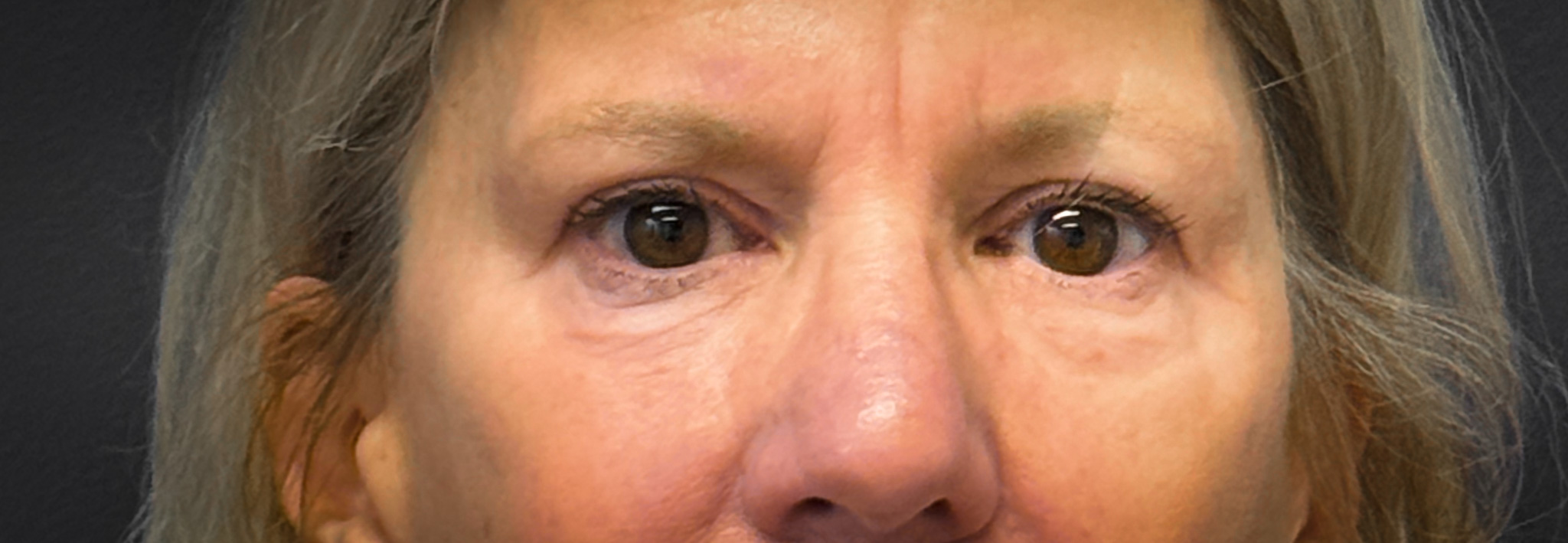 Blepharoplasty-Case--2653 | After Dr. Frank Albino 1