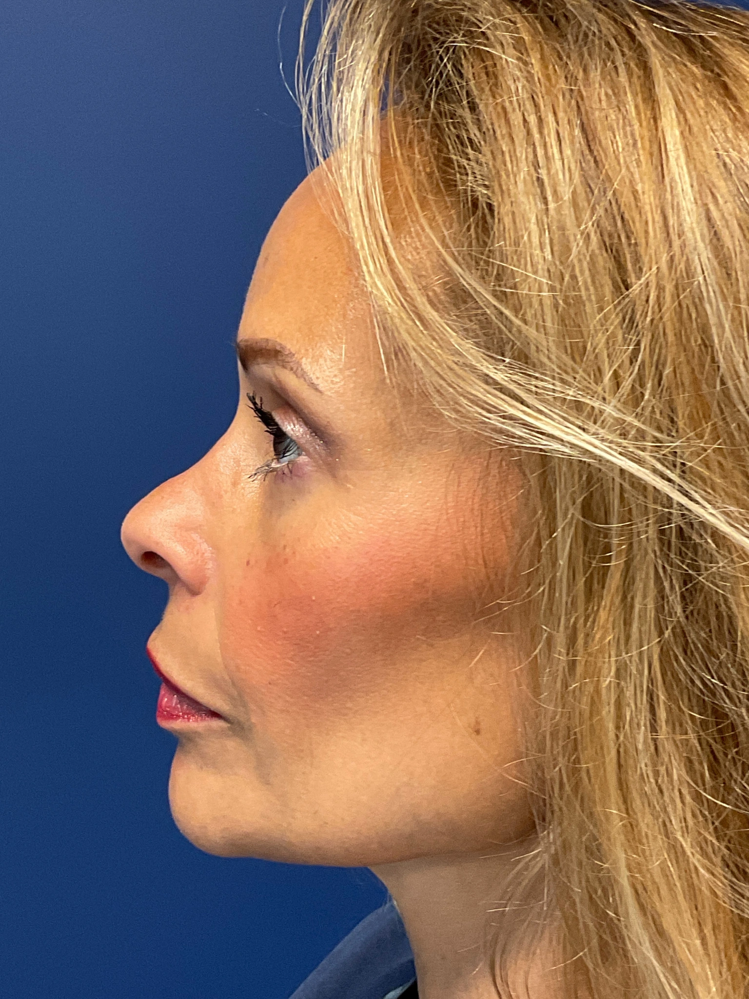 Facelift-and-Facial-Fat-Grafting-Case--4152 | After Facelift 3