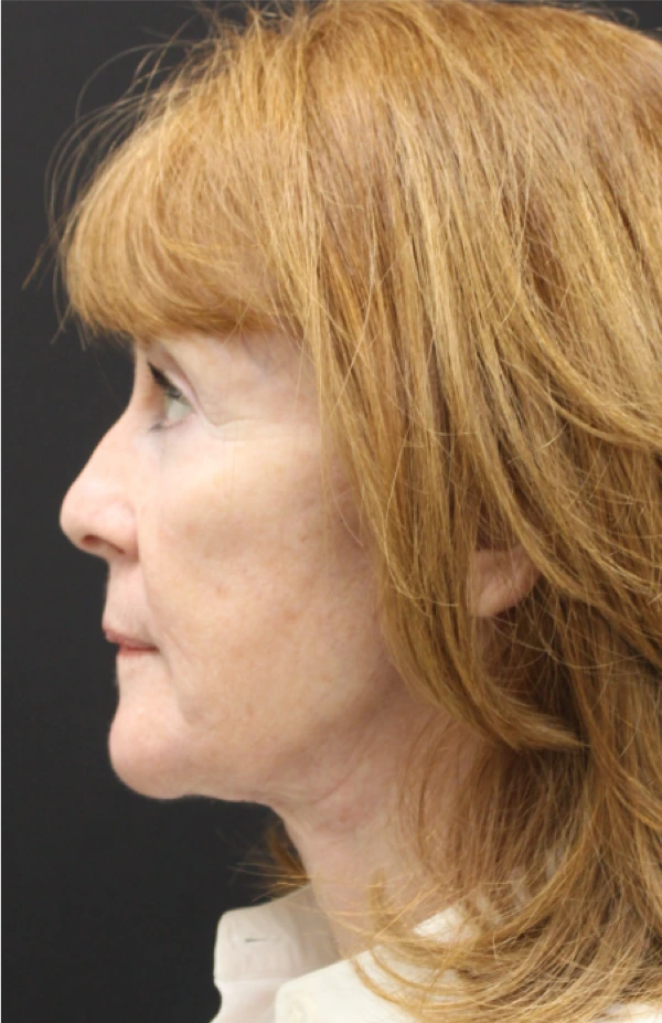 Necklift-Case--5698 | After Neck Lift 2