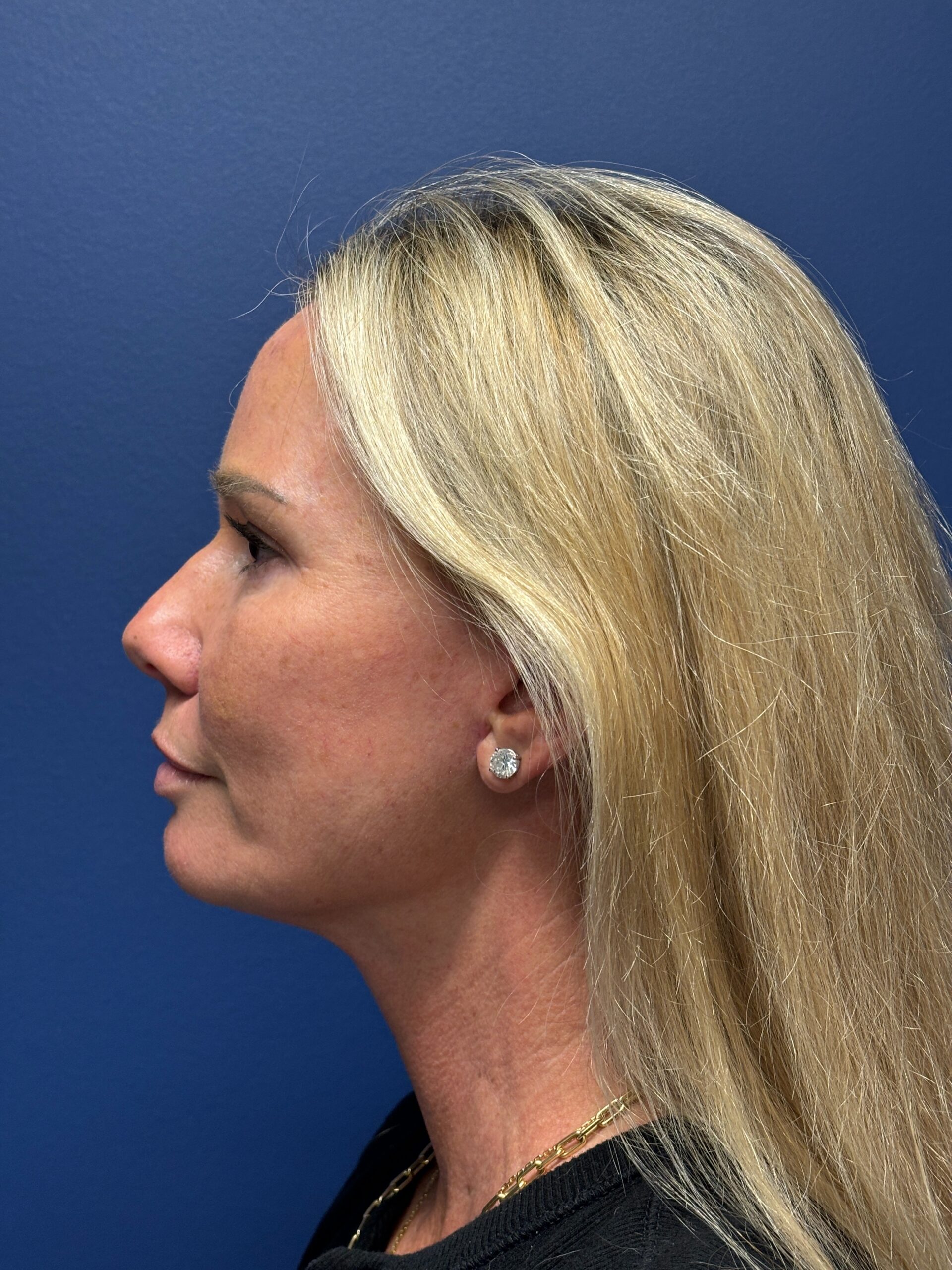 Quad-Blepharoplasty-Case--4265 | After Dr. Arjun Kanuri 2